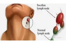 Kulakta Yağ Bezesi Tedavisi Nasıl Yapılır?