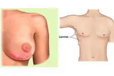 Memede Yağ Bezesi Belirtileri ve Tedavisi