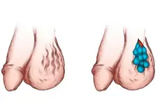 Testiste Yağ Bezesi Belirtileri ve Tedavisi