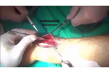 Bilekte Yağ Bezesi Belirtileri ve Tedavisi