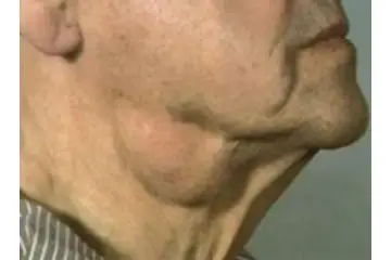 Boğazda Yağ Bezesi Belirtileri ve Tedavisi