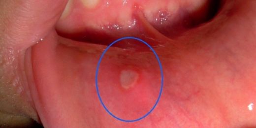 Ağız İçi Yağ Bezesi Belirtileri ve Tedavisi
